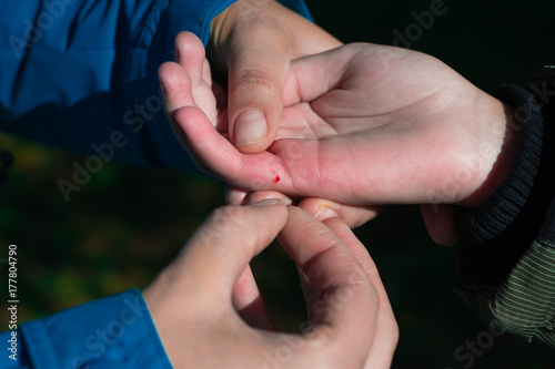 Canvas-taulu sharp bee sting with a bag of poison broke the skin and left it