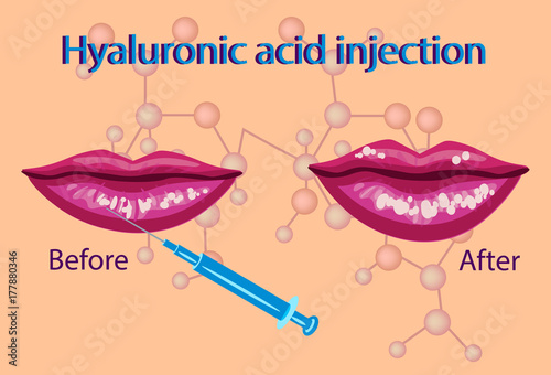 hyaluronic acid injection,lips procedure vector illustration,