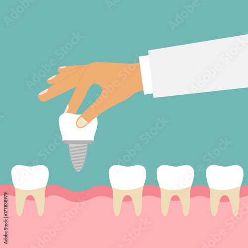 The hand holds the tooth implant. The hand sets the tooth.