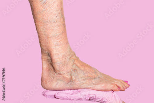 Foto Lower limb vascular examination because suspect of venous insufficiency