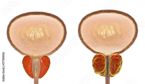 Benign prostatic hyperplasia, 3D illustration showing normal and enlarged prostate gland