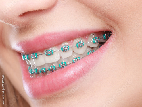 Closeup of woman teeth with braces photo