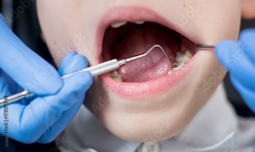 Close-up of dentist s hand examining teeth of child patient in dental office using probe and mirror. Dentistry