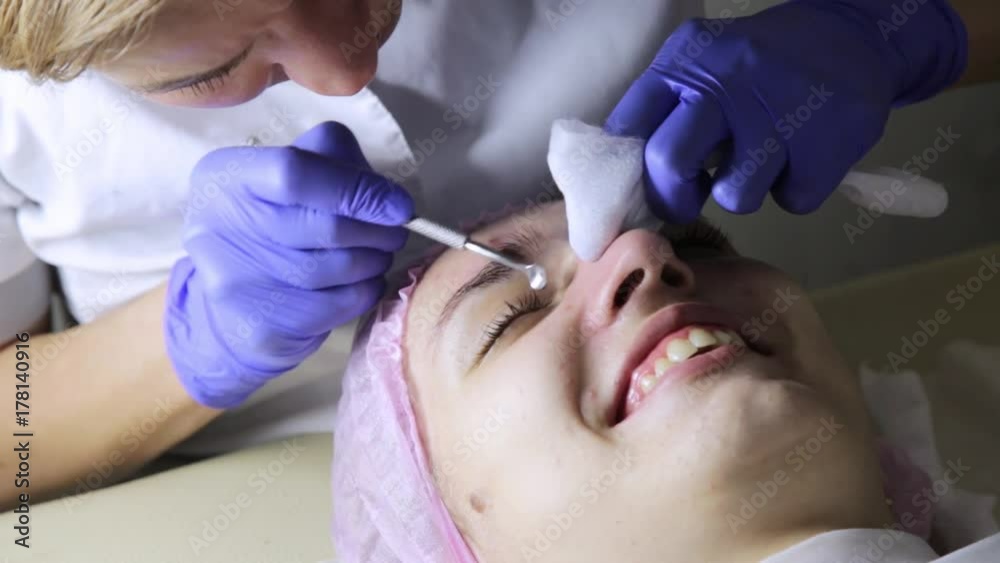 beautician squeezing pimple blackheads from nose with pimple popper tool beautician squeezing pimple blackheads from nose with pimple popper tool
