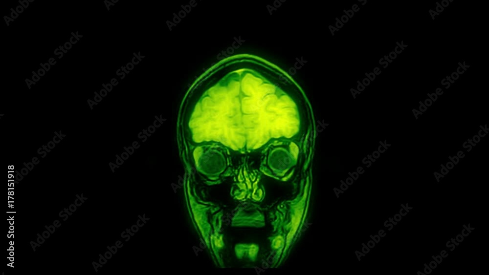 Computed medical tomography (CT/MRI) upscaled scan of healthy young female head. Front view. Discrete slices. Green on black background. Computed medical tomography (CT/MRI) upscaled scan of healthy young female head. Front view. Discrete slices. Green on black background.