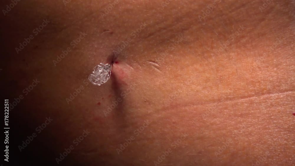 The doctor prepares the injection epidural
