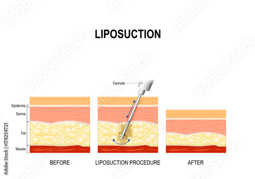 liposuction procedure. Before and after photo