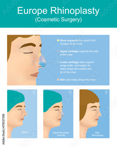 Rhinoplasty plastic surgery is a  plastic surgery creates a aesthetic, and facially proportionate nose for correcting or other problems that affect breathing. Illustration anatomy body.