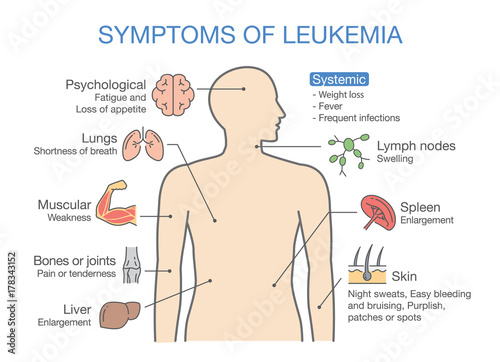 Common symptoms and signs of Leukemia. Medical illustration ideal for cancers diagram.
