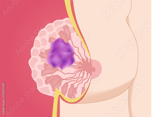 breast cancer in women breast vector