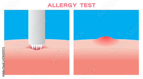 allergy test vector