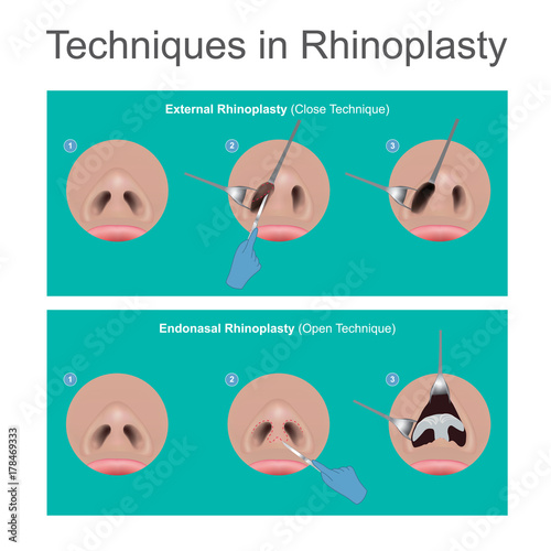 Techniques in rhinoplasty.