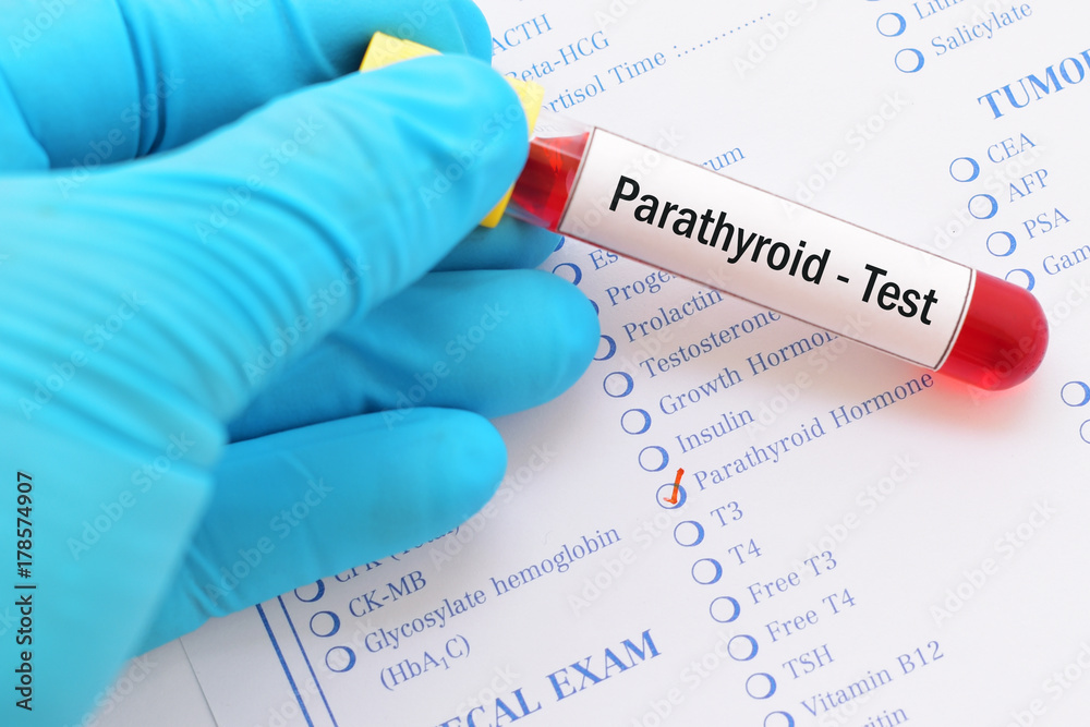 Blood sample with requisition form for parathyroid hormone test Stock