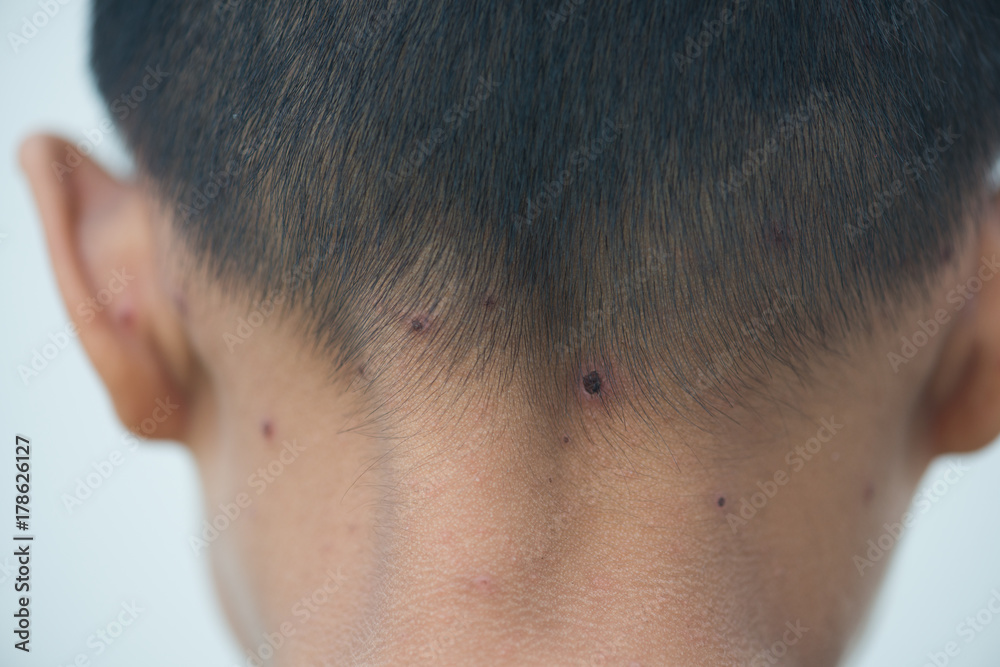 asian child with chicken pox asian child with chicken pox