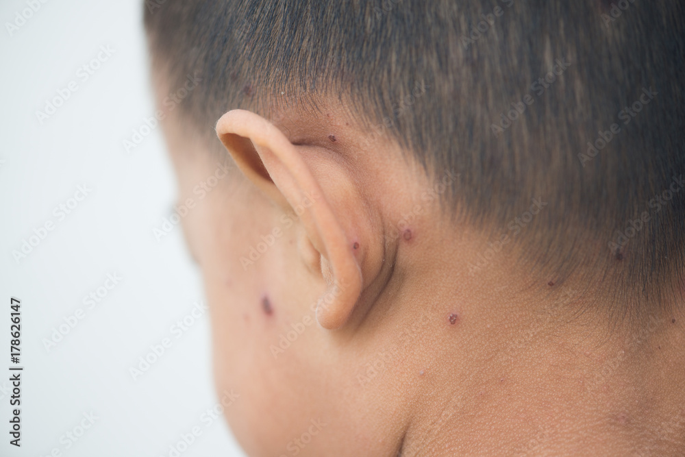 asian child with chicken pox asian child with chicken pox