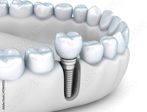 Fototapeta Naklejka Na Ścianę i Meble -  Tooth implant instalation process , Medically accurate 3D illustration white style