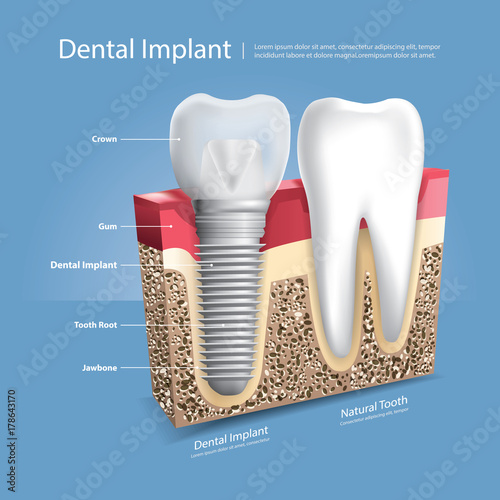 Human teeth and Dental implant Vector Illustration