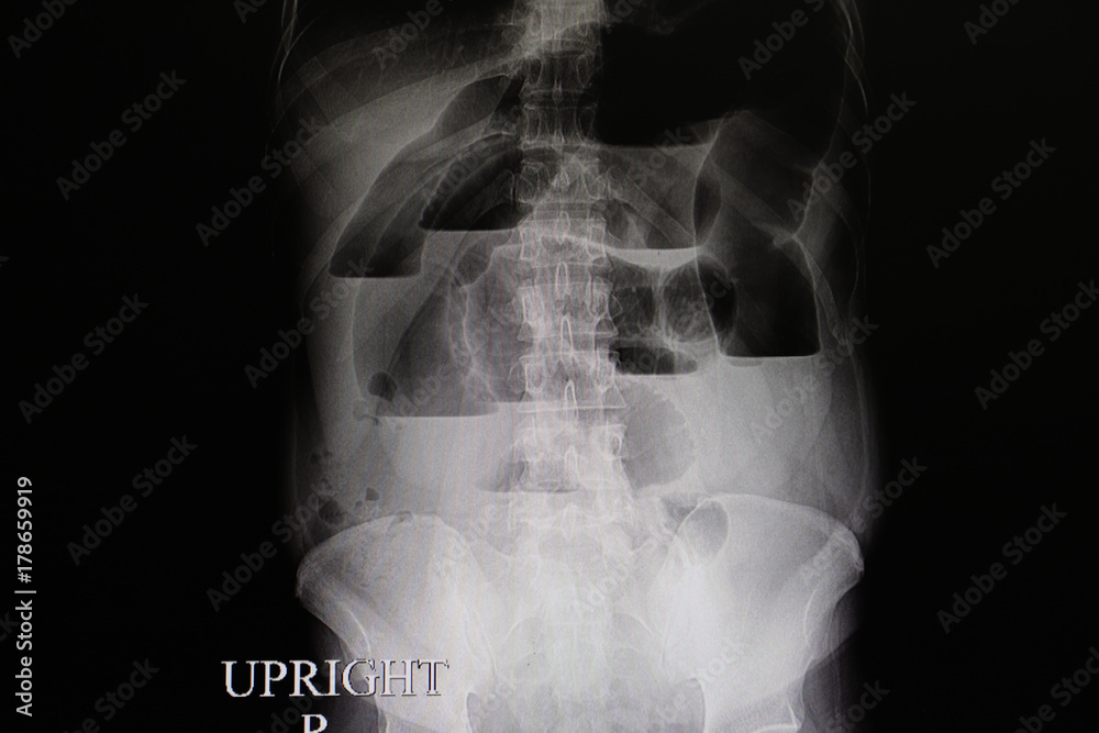 abdominal film of a patient with intestinal obstruction