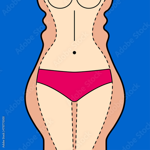 Liposuction