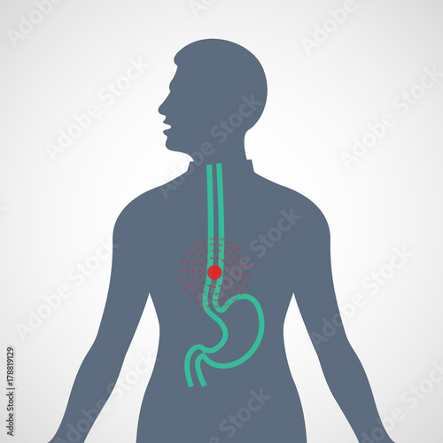 Esophageal Cancer vector logo icon illustration