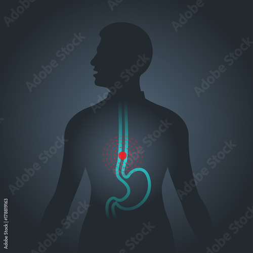Esophageal Cancer vector logo icon illustration