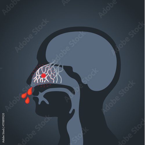 Nosebleed vector logo icon illustration