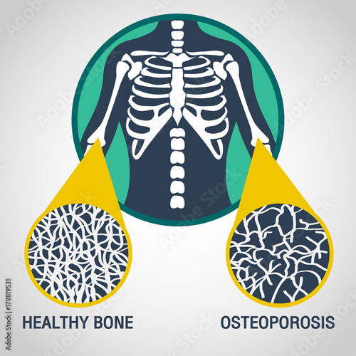 Osteoporosis vector logo icon illustration