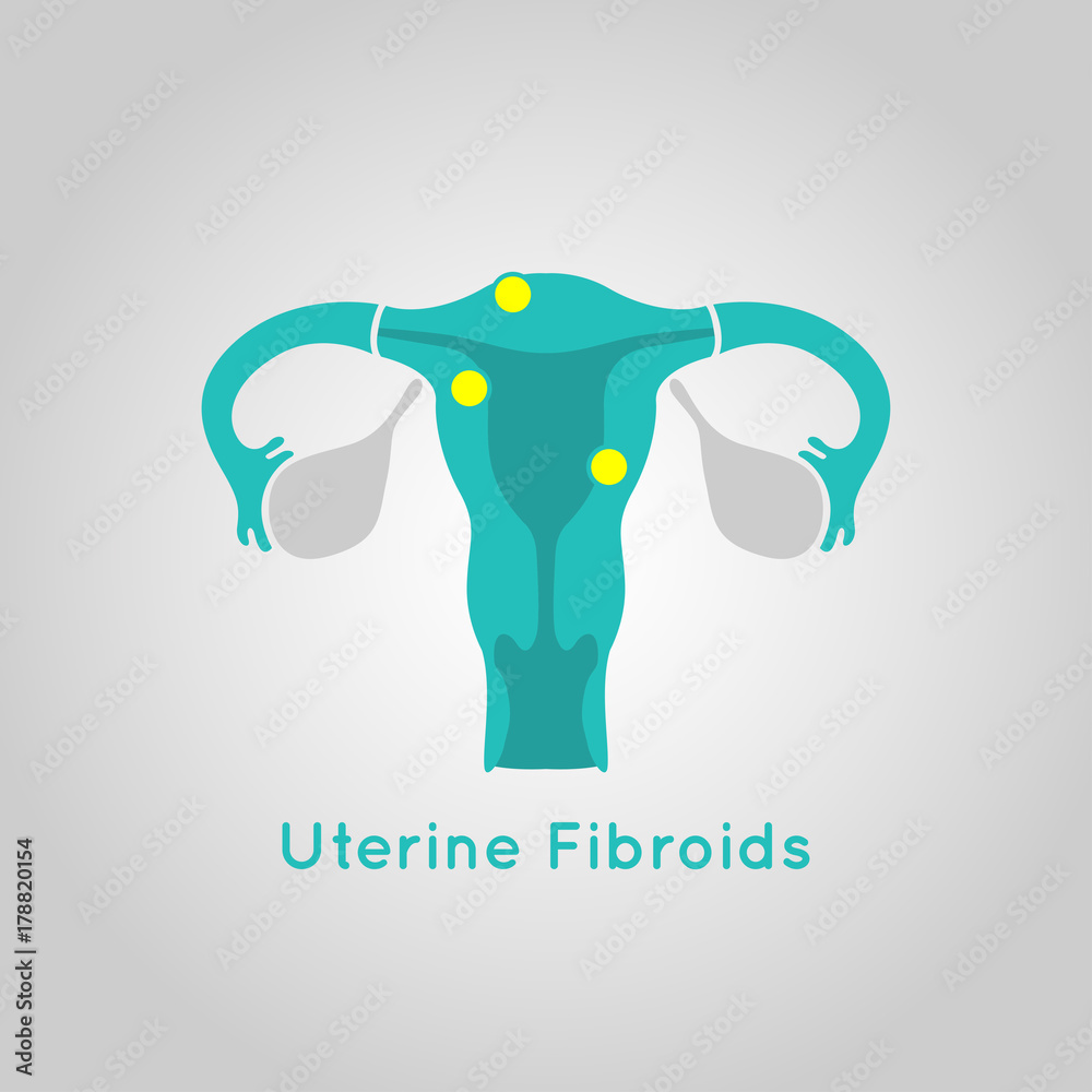 Φωτογραφία Uterine Fibroids logo vector icon design illustration