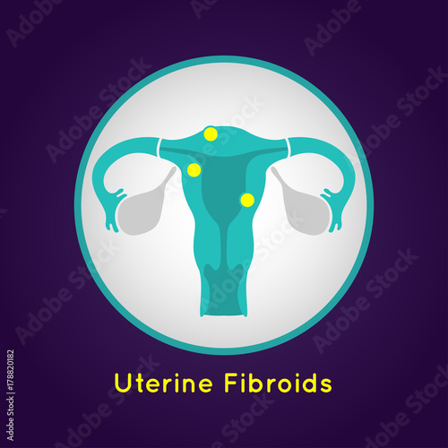 Uterine Fibroids logo vector icon design illustration