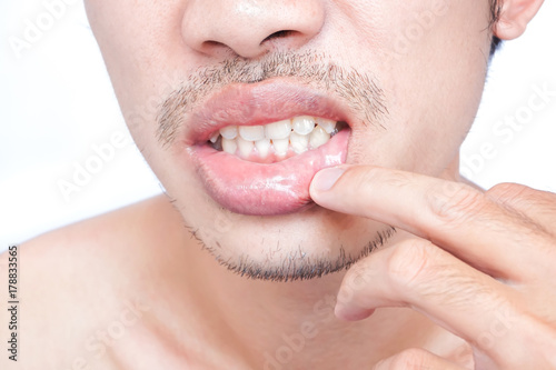 Closeup of lips man problem health care, Herpes simplex