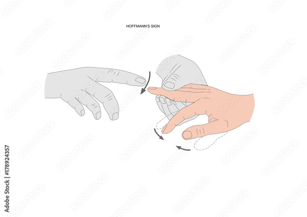 Hoffmann's sign, a neurological test to check if there is a motor neuron  (or motoneuron) lesion Stock Vector | Adobe Stock