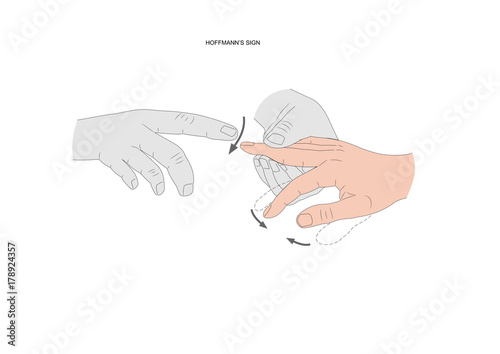 Hoffmann's sign, a neurological test to check if there is a motor neuron (or motoneuron) lesion