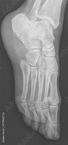 female feet xray radiograph