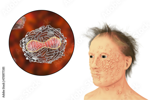 A man with smallpox infection and variola virus, a virus from Orthopoxviridae family that causes smallpox, highly contagious disease eradicated by vaccination, 3D illustration photo