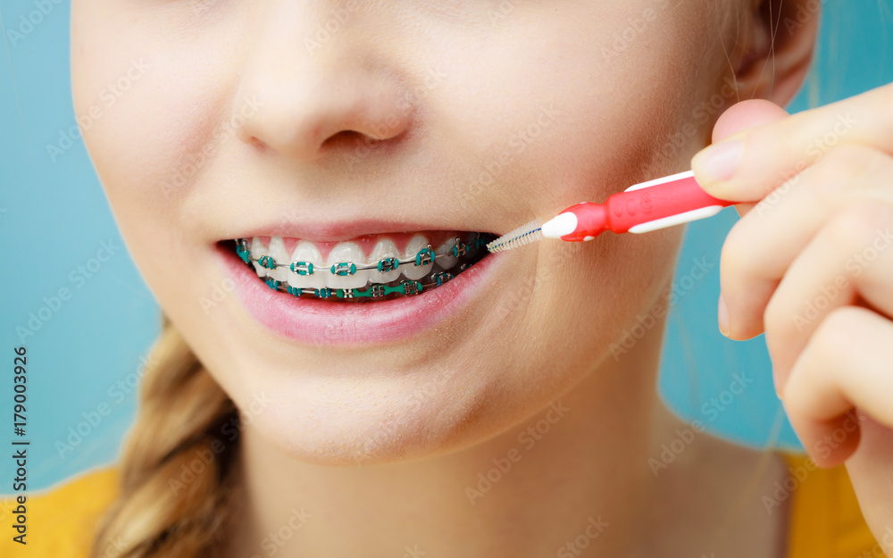 Woman with teeth braces using interdental brush Woman with teeth braces using interdental brush
