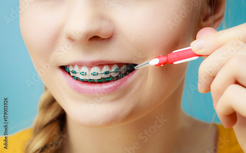 Woman with teeth braces using interdental brush