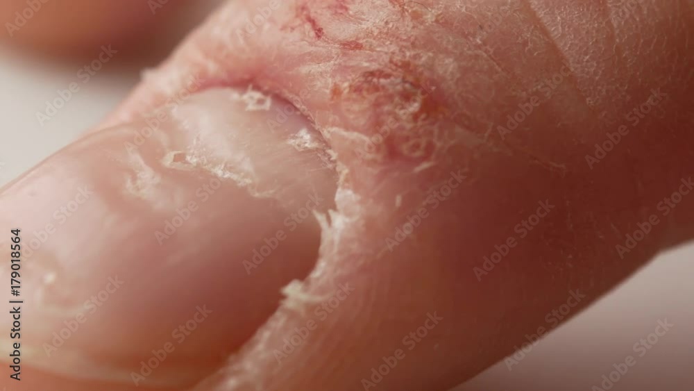 Fingers and nails of a patient with psoriasis. The man nervously knocks the tip of his finger on the table. Fingers and nails of a patient with psoriasis. The man nervously knocks the tip of his finger on the table.