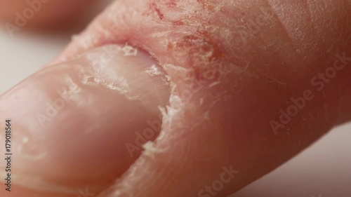 Fingers and nails of a patient with psoriasis. The man nervously knocks the tip of his finger on the table. photo