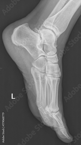 female feet xray radiograph