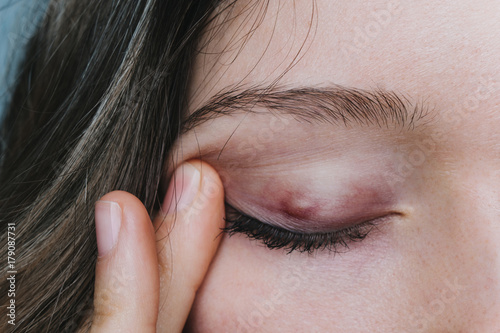 young girl shows a chalazion on the eyelid closeup photo