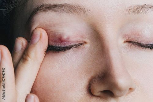 Tableau sur toile young girl shows a chalazion on the eyelid closeup