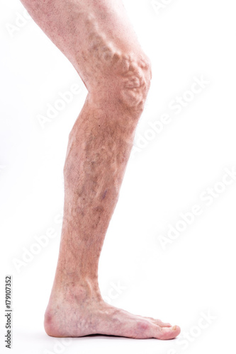 People with varicose veins of the lower extremities and venous thrombophlebitis and standing on a white background