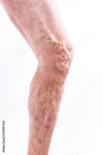 People with varicose veins of the lower extremities and venous thrombophlebitis and standing on a white background