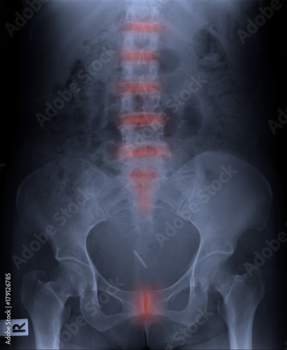 film x-ray pelvis and spinal column.
