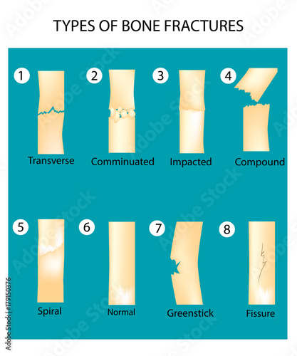 types of bone fractures