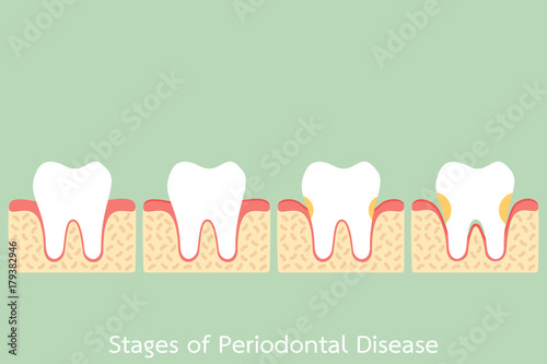 step of periodontal disease / periodontitis / gingivitis / gum disease, dental problem