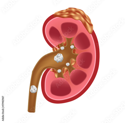Kidney stones medical concept vector . anatomy