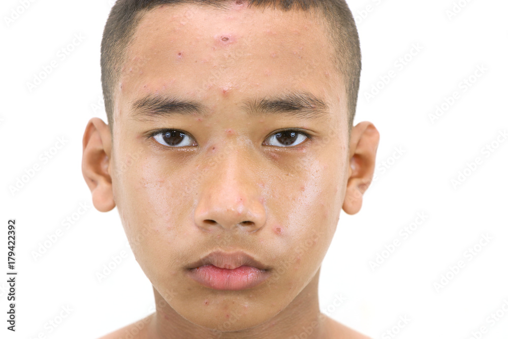 Obraz premium Chickenpox bubble rash on a boy.