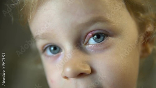 inflammation of the eye