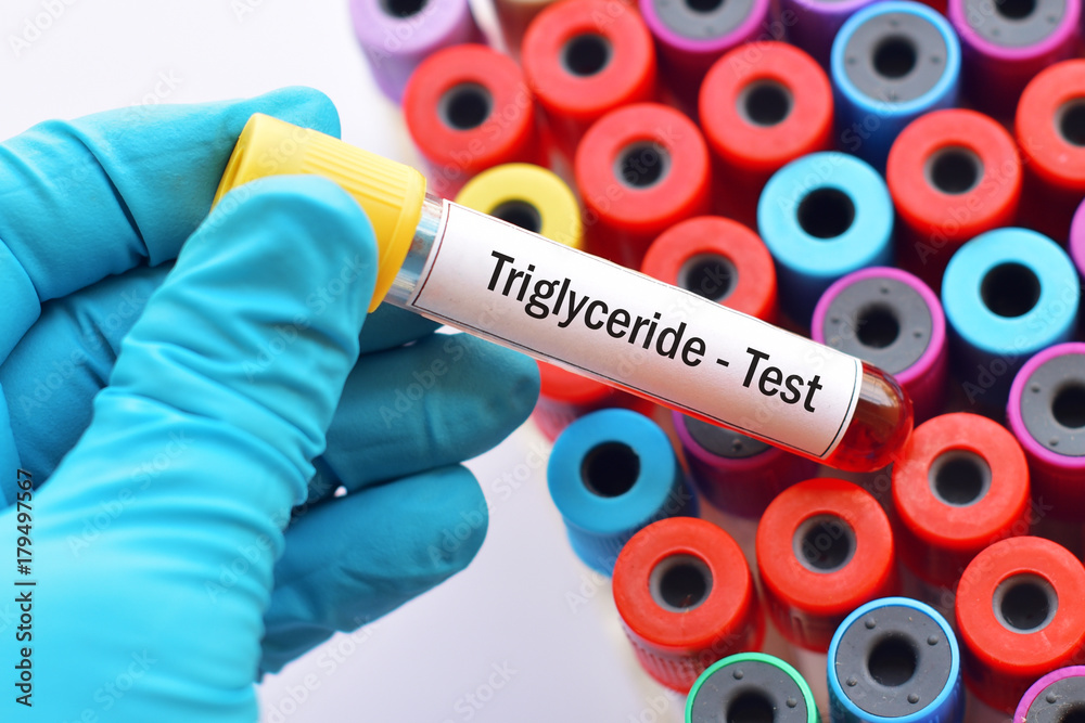 Fototapeta premium Test tube with blood sample for triglyceride test